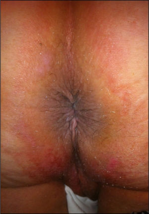 A follow-up image at three months after surgery that reveals a well-healed anastomosis with no sphincter dysfunction.