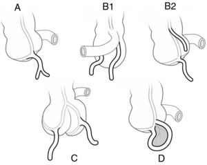 Modified Cave-Wallbridge classification. Type A, partial duplication of the appendix; Type B1 (bird type), two appendices are placed symmetrically on both sides of the ileocecal valve; Type B2 (taenia coli type), one appendix is in the usual place and the other is far along the taenia coli; Type C, duplication of cecum and appendix; Type D (horseshoe type), one appendix has two openings in the cecum; Bulut et al. (2016).6