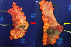 (A) External view of anterior rectosigmoidectomy product showing Chinese ink marking area of the tumor (red arrow). (B) Internal view of the specimen extirpated with vegetative lesion in the lumen of the colon (yellow arrow).