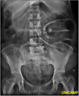 Simple abdominal radiograph showing dilated loops of the small intestine (jejunum) with visible convex valves, located mainly in the upper left quadrant.