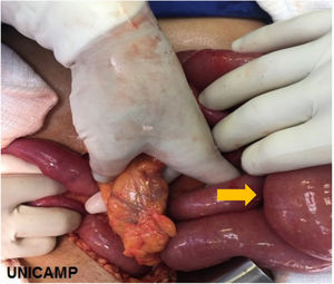 Intraoperative photograph where the descending colon is seen lowered with the hand of the surgeon circling the defect of the mesocolon. Jejunal loops passing through the defect toward left colic peritoneal reflection (arrow direction).