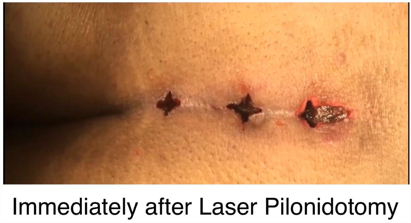 A Pilonidal Cyst Doctor Can Help Correct Non-Healing Pilonidal Surgical  Wounds