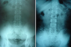 Terminal obstruction pattern (left) and colonic inertia pattern (right).