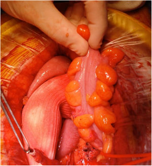 Dissection of colonic taenia.