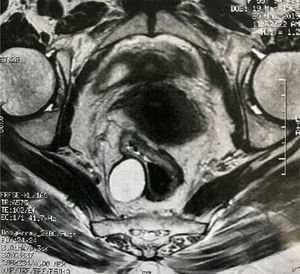Perianastomotic lesion evaluation by MRI.