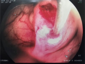 Attempt of transanal drainage of the perianastomotic lesion using a needle, during colonoscopy.