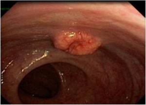 Proctoscope view of the rectal tumor.