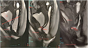 Pelvic MRI defecography showing a rectocele during the evacuation phase.