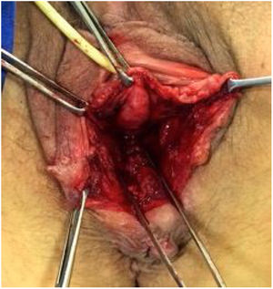 Complete plication of the anterior wall of the rectum, with rectocele repair.