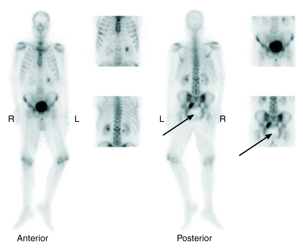 Fecal impaction detection on a bone scan | Revista Española de Medicina ...