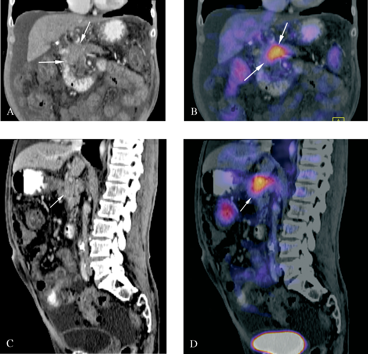 18F-FDG PET/CT for discrimination between tumor extension and blood ...