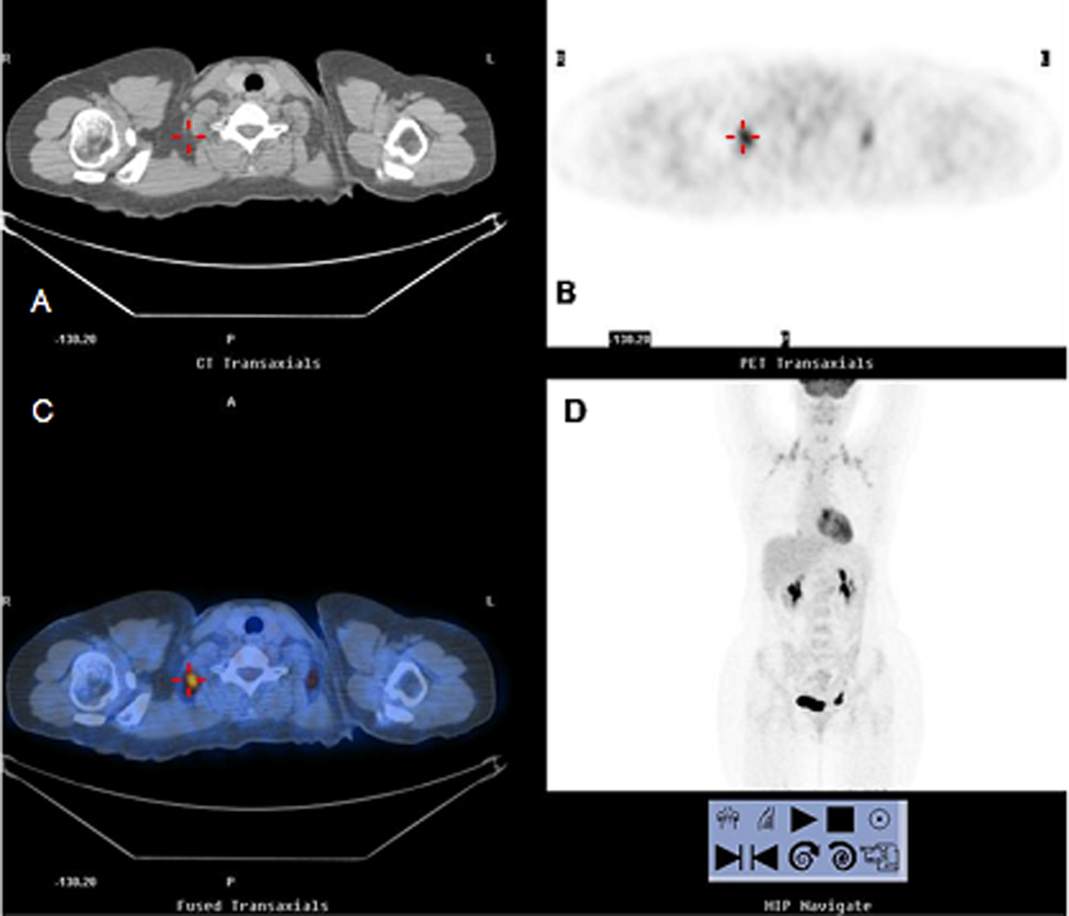 FDG uptake in brown adipose tissue—A brief report on brown fat with FDG ...
