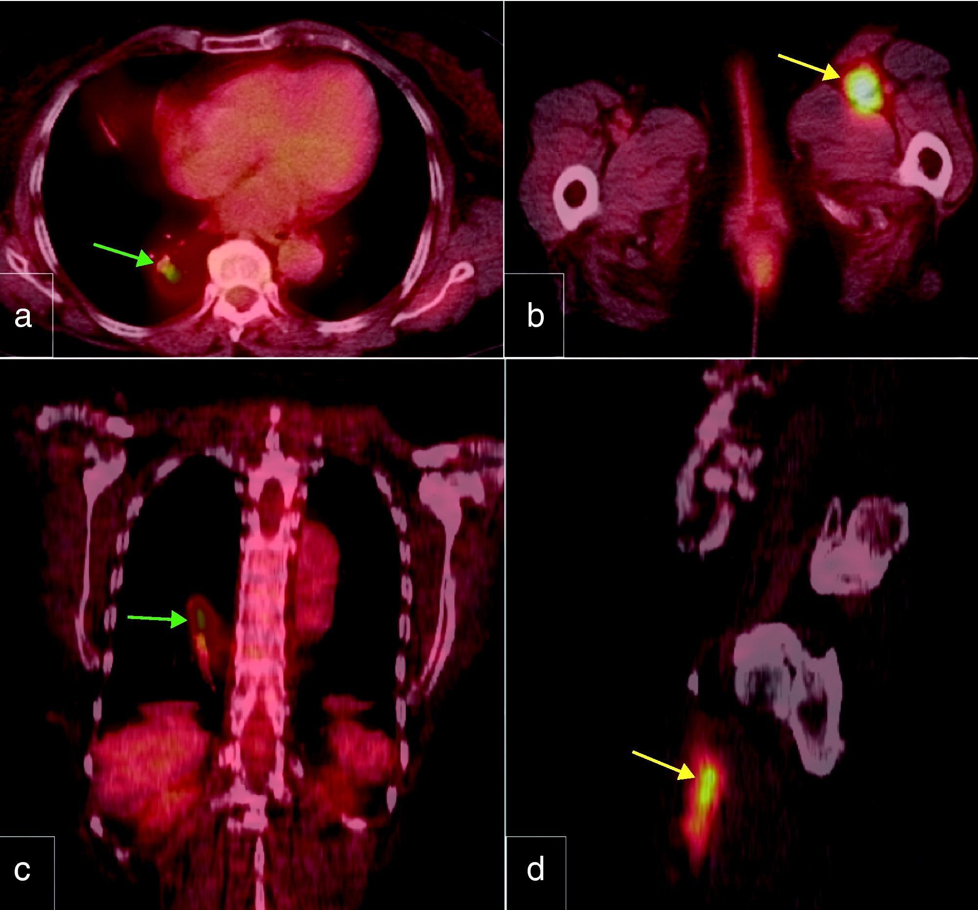 Tumor thrombosis detected on PET/CT scanning in a patient with ...