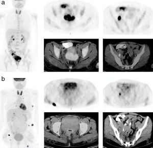 Pretreatment MIP of FDG-PET/CT data showed increased heterogeneous FDG uptake (SUVmax: 15.3) within large cervical mass together with internal and external iliac lymph nodes (a). Posttreatment MIP of FDG-PET/CT data (b) revealed focally increased (SUVmax: 5.4) within residual cervical mass and iliac lymph nodes, consistent with partial metabolic response and multiple hypermetabolic foci of FDG uptake within several muscles and subcutaneous areas.