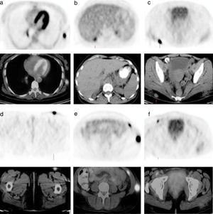 Posttreatment FDG-PET/CT revealed increased FDG uptake (SUVmax: 19.8) subcutaneous tissue in left lower lateral chest (a), hepatorenal area (b), right gluteal area (c), left upper anterior region of the thigh (d), left lower quadrant of abdominal wall and the left abdominal oblique muscle (e), and right iliopsoas muscle (f).