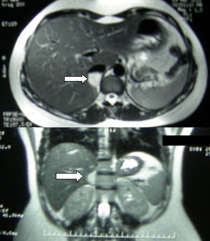 Imagen de resonancia magnética de abdomen en secuencia T2 (corte axial y coronal) que muestra un nódulo hiperintenso en la región suprarrenal derecha de 2,2×1,9cm (flecha) sugestivo de recurrencia de feocromocitoma.