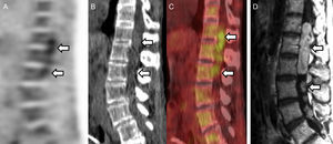 FDG PET/CT also showed heterogenous uptake in the spinal canal (SUV 4.1) (A–C) that corresponded to additional lesions (arrows) on T1 contrast MRI (D).