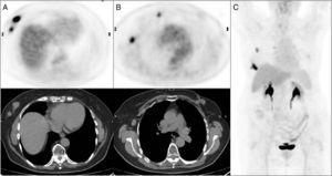 Multifocal right breast cancer in PET/CT axial images (A) with a clinically pathologic right axillary lymph node and a pathologic lymph node in right mammary territory showed in axial images of the PET/CT (B) unsuspected in conventional imaging techniques. Summary of the results on the maximum intensity projection PET imaging (C).