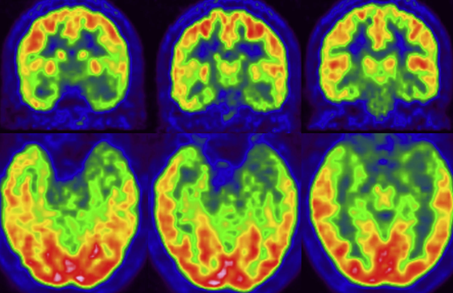 PET y SPECT en la epilepsia | Revista Española de Medicina Nuclear e ...