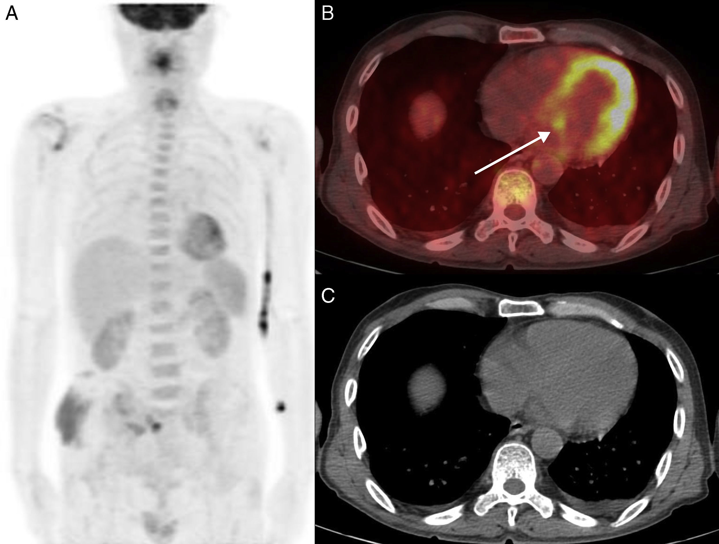 Pathologically proven infective endocarditis demonstrated on 18F-FDG ...