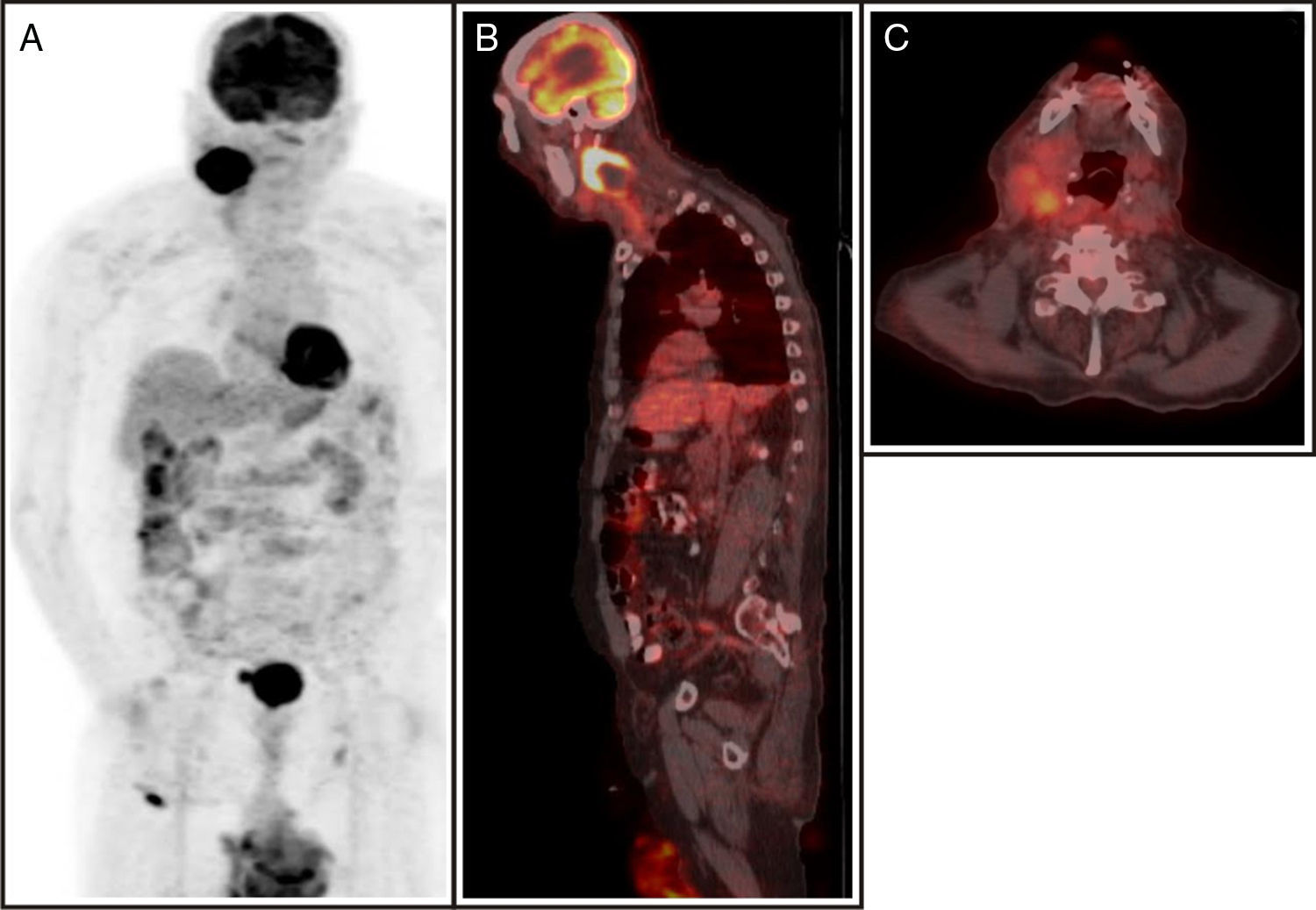 Incidental diagnosis of tumor thrombosis on FDG PET/CT imaging ...