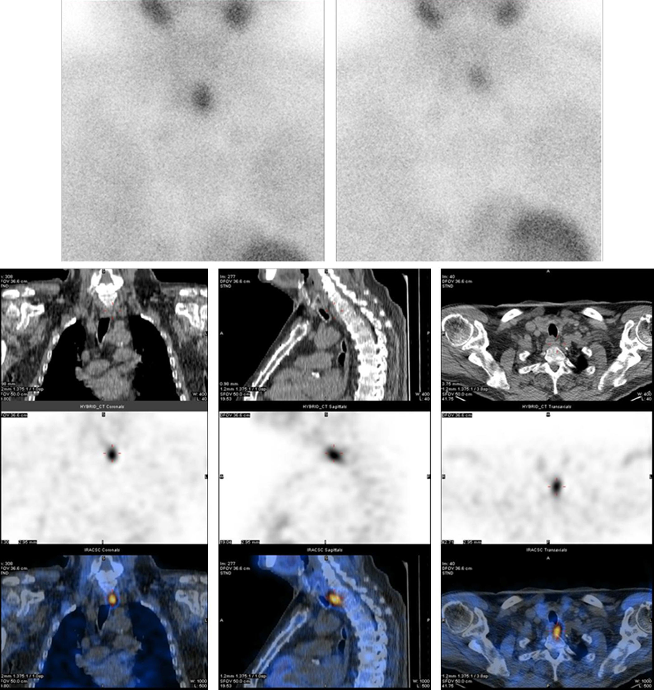Hybrid-fusion SPECT/CT systems in parathyroid adenoma: Technological ...