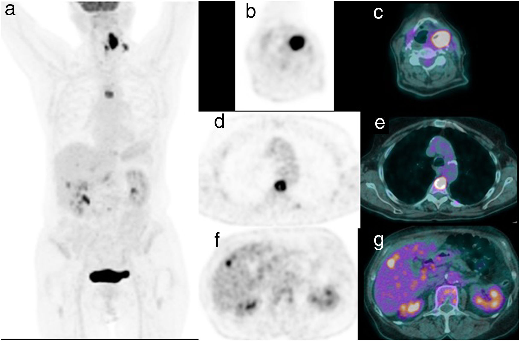 La PET/TC con 18F-FDG en el cáncer de laringe: comparación con técnicas ...