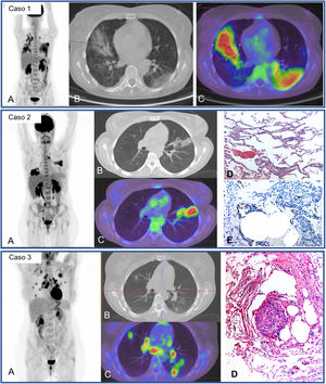 Caso 1. MIP (A) de paciente con fiebre de origen desconocido y síndrome de Sjögren en tratamiento con rituximab. Cuadro clínico compatible con COVID-19 (fiebre y TC con afectación parenquimatosa pulmonar bilateral) desde el 25 de marzo de 2020 con 3 PCR de exudado nasofaríngeo negativas. PET/TC un mes después que muestra intensa captación pulmonar bilateral coincidente alteraciones radiológicas visibles en los cortes axiales de TC (B) y PET/TC (C) y probable reactivación medular. Se realizó un posterior broncoaspirado que confirma, mediante PCR, la infección persistente por SARS-CoV-2. Caso 2. MIP (A) de paciente con esclerosis múltiple en tratamiento con rituximab y fiebre post-COVID de dos meses evolución. Captación patológica de elevada intensidad en ambos parénquimas pulmonares coincidiendo con áreas de opacificación en el TC y PET/TC (B, C). Se realizó posterior biopsia transbronquial con el resultado de neumonitis linfocitaria T (D) y mediante tinción inmunohistoquímica en tejido pulmonar, se evidenció la persistencia del SARS-CoV-2 (E). Caso 3. MIP (A) de paciente joven sin antecedentes de interés con disnea post-COVID de ocho meses de evolución. Muestra múltiples captaciones nodulares en ambos pulmones y captación hiliomediastínica bilateral, coincidentes con áreas de opacificacion del parénquima y adenopatías no aumentadas de tamaño (B, C). El estudio histológico ganglionar obtenido por ecobroncoscopia (D) mostró inflamación granulomatosa no necrotizante de tipo sarcoide. La biopsia transbronquial posterior, demostró el mismo tipo de inflamación granulomatosa sin presencia de virus en la inmunotinción.