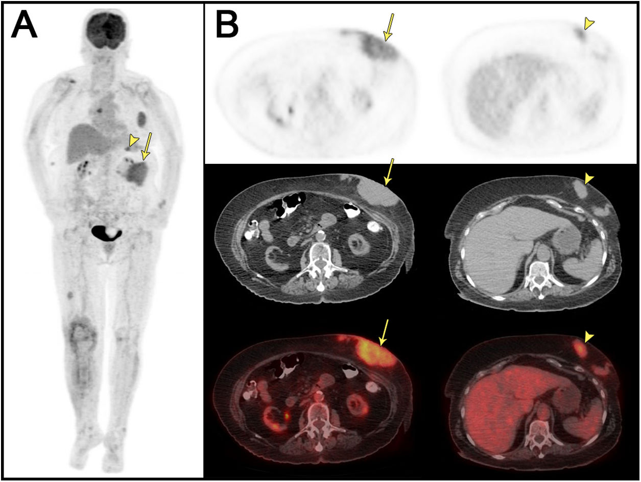 Afectación Cutánea en el Mieloma Múltiple Demostrada con FDG PET/TC ...