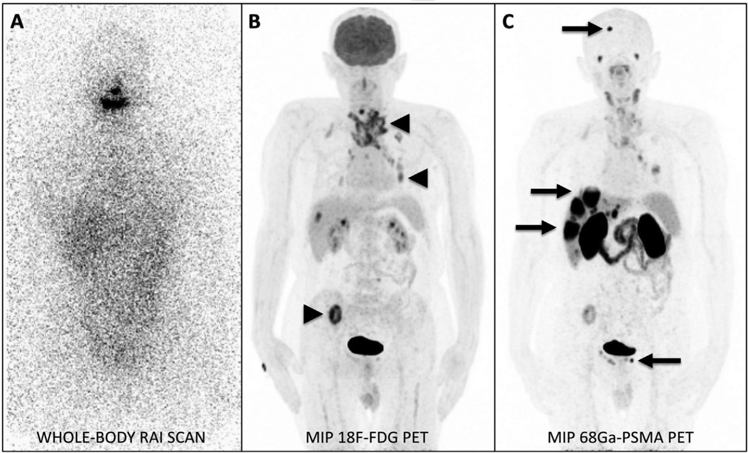 Captación de 68Ga-PSMA en un paciente con cáncer de tiroides ...