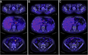 Evolución del linfoma en imágenes axiales de fusión [18F]FDG PET/C. A)Estudio [18F]FDG PET/TC de recaída: 30 de junio de 2020. B)Estudio [18F]FDG PET/TC tras quimioterapia: 10 de septiembre de 2020. C)Estudio tras infección de SARS-COV-2: 16 de diciembre de 2020. La serie de flechas superiores señalan el ganglio linfático retropectoral izquierdo (nivel T2), la serie de flechas intermedias señalan la masa retropancreática (niveles T11-T12, hilio hepático) y la serie de flechas inferiores señalan el ganglio linfático iliaco izquierdo (niveles L4-L5, bifurcación de la aorta).