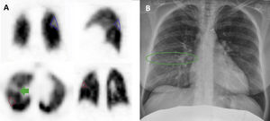 SPECT de perfusión pulmonar realizada a la paciente 5 que muestra defectos de perfusión subsegmentarios en segmentos superiores de LII (A, azul, en cortes coronal y sagital) y LID (rojo, en cortes axial y coronal), sin correspondencia con condensaciones en la imagen radiológica que los justifiquen (B), siendo compatibles con TEP. Además, se aprecia un defecto de captación lineal horizontal (flecha verde) que se continúa en cortes craneales de SPECT en sentido posterior, correspondiéndose radiológicamente con mínimo engrosamiento de la cisura menor (círculo verde).