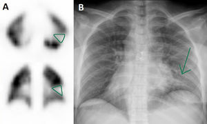 Corte axial y coronal de la gammagrafía de perfusión pulmonar realizada a la paciente 4 que muestra un defecto de tamaño subsegmentario en segmento superior de LII (A, verde), que coincide con infiltrado radiológico (B, flecha).