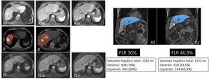 Paciente de 69 años con hepatocarcinoma binodular. No enfermedad a distancia. Función hepática conservada. Se aprecian dos lesiones en la resonancia magnética en segmentos VII y VIII (A). En imágenes A1b y A1c se aprecia que la lesión del segmento VIII está en contacto con la vena suprahepática derecha. Esto, unido al hecho de que el remanente hepático tras una hepatectomía derecha sería de 30% (A2), hicieron que se plantease la realización de una RE con la doble finalidad de downstaging e hipertrofia del remanente hepático. En el estudio PET-90Y (B) tras la administración por la arteria hepática derecha de 1,5 GBq de 90Y-microesferas de resina, se comprobó la adecuada llegada del tratamiento a las lesiones tumorales (dosis absorbida media de 185 Gy) y al tejido no tumoral hepático derecho (dosis absorbida media de 76 Gy; V30 56%). A los cinco meses de la radioembolización se comprobó (C1) la separación de la lesión del VIII de la vena adyacente (C1b y C1c), junto a una adecuada hipertrofia del remanente (C2). El paciente fue tratado mediante hepatectomía derecha laparoscópica (no requirió transfusión; tres días de ingreso). En la fecha de la última revisión (72 meses tras la cirugía), el paciente seguía vivo y libre de enfermedad.
