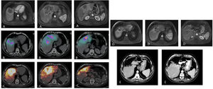 Paciente con carcinoma de recto estadio IV por metástasis única que afecta los segmentos centrales IVa, IVb y VIII tratada con quimioterapia neoadyuvante (FOLFOXIRI) con respuesta minor (A). Con la intención de reducir el tamaño tumoral (que requería cirugía hepática extrema) y como test del tiempo (primario no resecado y comportamiento tumoral incierto), se valora al paciente como candidato a RE. La SPECT/TC tras la inyección de MAA a través de las arterias segmentaria del VIII y accesoria de la hepática izquierda (B) muestra el adecuado acceso al tejido tumoral, con llegada a parte del tejido no tumoral pero con preservación de todos los segmentos hepáticos posteriores. Se administran 2,3 GBq de 90Y-microesferas de resina. El estudio dosimétrico en el PET de 90Y (C) calcula una dosis absorbida media en el tumor de 120 Gy y en el tejido no tumoral de 74,7 Gy. El estudio de resonancia magnética ocho meses después de la RE (D) muestra una reducción significativa del tamaño tumoral, lo que permite realizar una hepatectomía central laparoscópica (E) con mínima pérdida de sangre e ingreso de tres días. El paciente sigue vivo 72 meses después de la RE y ha permanecido libre de enfermedad tumoral hepática 54 meses tras la cirugía (presentó lesión metastásica en el segmento V/VIII que fue nuevamente resecada).