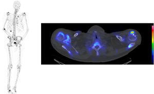 Gammagrafía ósea de cuerpo completo con SPECT-CT CZT realizado tras la administración intravenosa de 500MBq de 99mTc-HDP, que no muestra captación sospechosa de metástasis esqueléticas. El SPECT-CT CZT axial no muestra signos de metástasis en la escápula derecha.