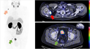 PET-CT realizado tras la administración de 220MBq de 68Ga-PSMA-11 que muestra captación elevada en la escápula derecha (flecha roja) y en un ganglio de 9mm en la grasa perirrectal (flecha verde), sugestivo de metástasis.