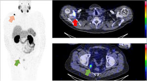 SPECT-CT CZT realizado tras la administración intravenosa de 750MBq de 99mTc-MIP-1404 que muestra aumento de la captación de trazador en la escápula derecha (flecha roja) y en un ganglio de 9mm en la grasa perirrectal (flecha verde), sugestivo de metástasis.
