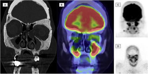 Imágenes de una paciente de 45 años diagnosticada de ECD. A)El corte coronal de la TC a nivel del macizo facial muestra una osteoesclerosis con engrosamiento de las paredes del seno frontal, esfenoidal y maxilar. B)El corte coronal de la 2-[18F]FDG-PET/TC muestra un hipermetabolismo a nivel de los senos paranasales con engrosamiento mucoso. C)La imagen MIP de la 2-[18F]FDG-PET craneal muestra actividad metabólica a nivel de los senos paranasales. D)La imagen planar de una gammagrafía ósea a nivel craneal muestra actividad osteogénica a nivel de los senos paranasales comparable con la imagenC.