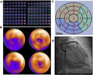 Mujer de 70 años, IMC 26, diabetes mellitus tipo II, fumadora, sin antecedentes cardiológicos previos. Diagnostico reciente de cáncer gástrico, se realiza una ecocardiografía como parte del estudio preoperatorio donde se observa una hipocinesis apical. Es remitida a IPM para descartar isquemia. Evaluación de la IPM sin SAPCA (imágenes en el lado izquierdo). IPM cortes de eje menor, de eje mayor vertical y eje mayor horizontal durante estrés en la fila superior y reposo en la fila inferior (A) y “ojo de buey” (B), mostrando un defecto de perfusión parcialmente reversible en la pared inferoseptal que afecta incluso el territorio apical. Mapa polar de imágenes gated durante el estrés mostrando contracción anormal moderada del ventrículo izquierdo (C). Ausencia obstrucción significativa de las arterias coronarias en la AC (D). IMP usando SAPCA (imágenes en el lado derecho) que muestran ausencia de defectos de perfusión significativos. La paciente pudo haber evitado la AC.
