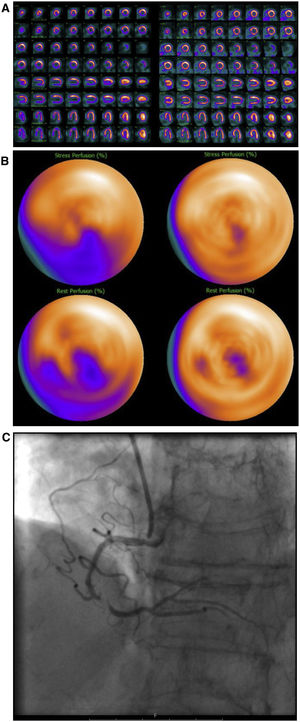 Mujer de 74 años, IMC 25, sin antecedentes cardiológicos previos. Presenta angina y electrocardiograma patológico. Es referida a una prueba de IPM para descartar isquemia. Evaluación de la IPM sin SAPCA (imágenes en el lado izquierdo). IPM cortes de eje menor, de eje mayor vertical y eje mayor horizontal durante estrés en la fila superior y reposo en la fila inferior (A) y “ojo de buey” (B), muestran un defecto de perfusión en la pared infero-septal, correspondiendo con el territorio de la arteria coronaria derecha, mostrando reversibilidad parcial en reposo. Obstrucción significativa de la arteria coronaria derecha comprobada con AC (C). IMP usando SAPCA (imágenes en el lado derecho) que muestran ausencia de defectos de perfusión significativos. Resultado falso negativo al usar SAPCA.