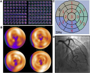 Varón de 69 años, IMC 31, antecedentes de fibrilación auricular. Presenta cambios patológicos en la onda ST-T en el electrocardiograma durante una prueba de esfuerzo. Referido a una prueba de IPM para descartar isquemia. Evaluación de la IPM sin SAPCA (imágenes en el lado izquierdo). IPM cortes de eje menor, de eje mayor vertical y eje mayor horizontal durante estrés en la fila superior y reposo en la fila inferior (A) y “ojo de buey” (B), mostrando un defecto de perfusión infero-apical con reversibilidad inferior durante el reposo. Mapa polar de imágenes gated durante el estrés mostrando contracción anormal moderada del ventrículo izquierdo (C). Ausencia obstrucción significativa de las arterias coronarias en la AC (D). IMP usando SAPCA (imágenes en el lado derecho) que muestran ausencia de defectos de perfusión significativos. El paciente pudo haber evitado la AC.