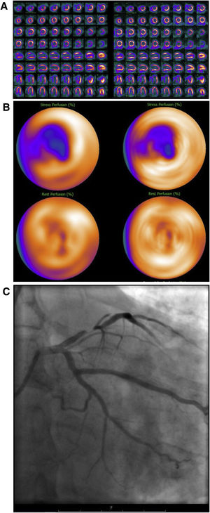 Varón de 50 años, IMC 29, antecedentes de hipertensión, hiperlipemia y angina típica. Referido a una prueba de IPM para descartar isquemia. Evaluación de la IPM sin SAPCA (imágenes en el lado izquierdo). IPM cortes de eje menor, de eje mayor vertical y eje mayor horizontal durante estrés en la fila superior y reposo en la fila inferior (A) y “ojo de buey” (B), mostrando un defecto de perfusión en la pared anterior, reversible en el estudio de reposo. Obstrucción significativa de la arteria coronaria descendente izquierda en la AC (C). IMP usando SAPCA (imágenes en el lado derecho) que muestran ausencia de defectos de perfusión significativos en la pared anterior, reversible en el estudio de reposo. Estudio verdadero positivo en la evaluación con y sin SAPCA, confirmado en la AC.