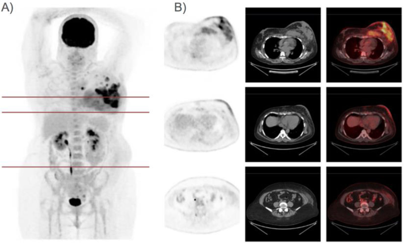 Papel de la [18F]FDG PET/TC en la valoración del carcinoma ductal ...