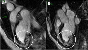 Imagen de 2 (A) y 3 cámaras (B) en telediástole de secuencia de realce tardío de gadolinio. Se observa una hipertrofia a nivel inferior apical y ápex estricto con presencia de realce tardío de distribución transmural en ambos segmentos. Muy probable trombo laminar. En las secuencias de cine (no adjuntadas por su formato video) se evidencia un ventrículo izquierdo no dilatado con FEVI en el límite bajo de la normalidad (FEVI 54%).