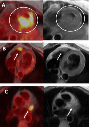 Imágenes axiales de fusión PET/RM y axiales en secuencias de sangre negra de la RMC. Hipercaptación de [18F]F-FDG en los segmentos inferiores medio-apical y ápex del VI que se encuentra engrosado en la RMC (A), con foco activo en la pared anterior del ventrículo derecho, con ligero engrosamiento en la RMC (B) e hipercaptación del trazador en la orejuela izquierda, sin practica traducción en la RMC (C).