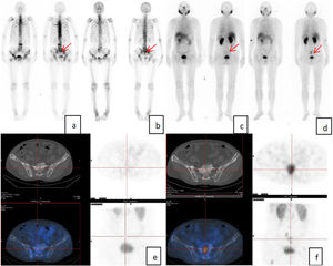 Varón de 77 años diagnosticado de CaP hace un año, con PSA de 3.903 ng/ml, FA de 203 U/L. La gammagrafía ósea de cuerpo entero sugería múltiples metástasis (A). La gammagrafía ósea tras un año de terapia endocrina mostró un leve descenso en la intensidad de la captación (B); PSA 15.73ng/ml, FA 81U/L. Se realizó una gammagrafía con [99mTc]Tc-PSMA (C, E), que mostró que existía destrucción ósea en muchas localizaciones de los huesos y alguna captación de PSMA estaba ligeramente incrementada, considerando que la actividad tumoral estaba todavía presente en algunas lesiones tras el tratamiento de las metástasis óseas. Tras 6meses de retratamiento, la reevaluación de PSA fue 47,30 ng/ml, FA fue 107 U/L y la imagen con [99mTc]Tc-PSMA (D, F) indicaron que la actividad tumoral de algunas lesiones tras el tratamiento de las metástasis óseas todavía estaba presente y el grado de concentración se había incrementado comparado con el tratamiento previo (que muestra la flecha roja en la misma localización).