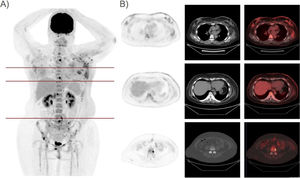 A) Imagen MIP (proyección de máxima intensidad) en la que se observa una importante progresión de la enfermedad oncológica de base (SUVmáx actual de la mama izquierda de 8,9 g/ml). B) Imágenes PET, TC y de fusión PET/TC en plano axial y ventana mediastino y ósea, en las que se puede observar afectación tumoral a nivel de ambas mamas y múltiples lesiones óseas de nueva aparición. Asimismo, destaca una notable progresión del componente inflamatorio asociado.