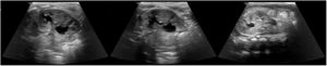 Ecografía abdominal a los dos días de vida. El riñón izquierdo mide 5,0cm de longitud (prenatal 4,6cm). El cáliz inferior izquierdo está ligeramente dilatado y mide hasta 8,4mm (prenatal 8,2mm) con un uréter izquierdo prominente. El cáliz superior izquierdo es más redondeado, y la pelvis renal mide hasta 5mm. Los hallazgos sugieren la sospecha de un doble sistema colector izquierdo.