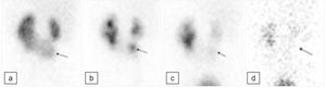 Renograma isotópico con [99mTc]Tc-MAG3 y diurético realizado a los 18 meses de vida; proyección posterior. a) Fase precoz de captación parenquimatosa. Se observa un RH con el hemiriñón izquierdo más grande que el derecho. El istmo del RH protruye inferiormente (flecha negra); este componente muestra cierta estasis urinaria en el sistema colector (b); hay un buen drenaje al final del estudio dinámico con el paciente en decúbito supino (c) y un mayor drenaje tras el cambio de postura y la micción (d). La apariencia no es la de un simple RH: el componente que protruye hace sospechar que se trata de un riñón supernumerario en el RH. Esto se ha confirmado en estudios radiológicos posteriores (fig. 3). RH: riñón en herradura.